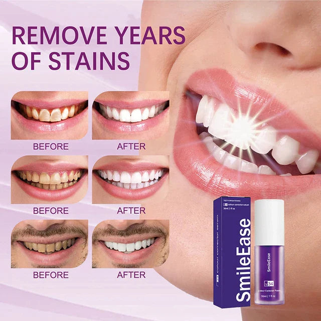 Hismile Instant Teeth Whitening