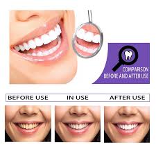 Hismile Instant Teeth Whitening